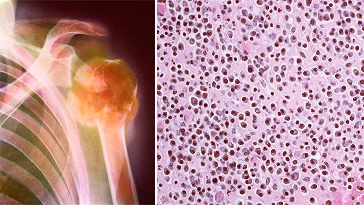 Multiple Myeloma