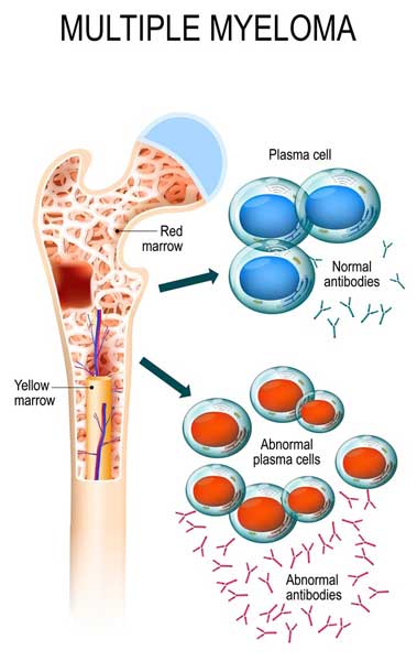 Multiple Myeloma