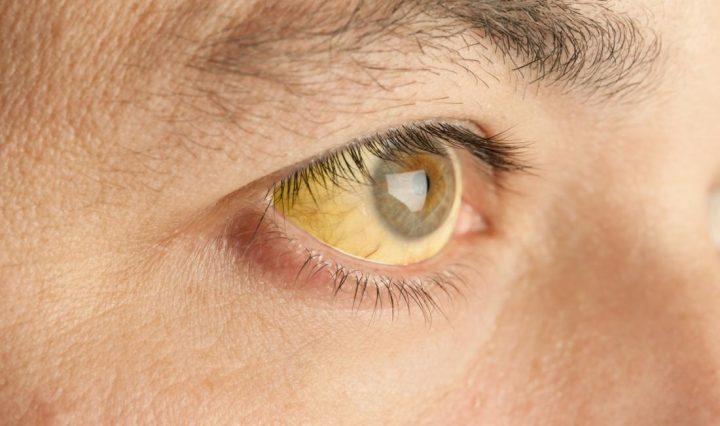 gilbert's syndrome